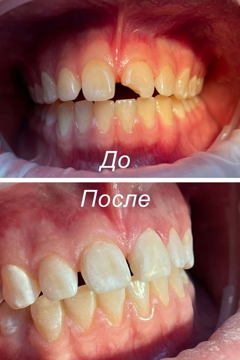 Фото работы врача «Асманова Оксана Сергеевна» - Реставрация зуба с соблюдением особенностей анатомии