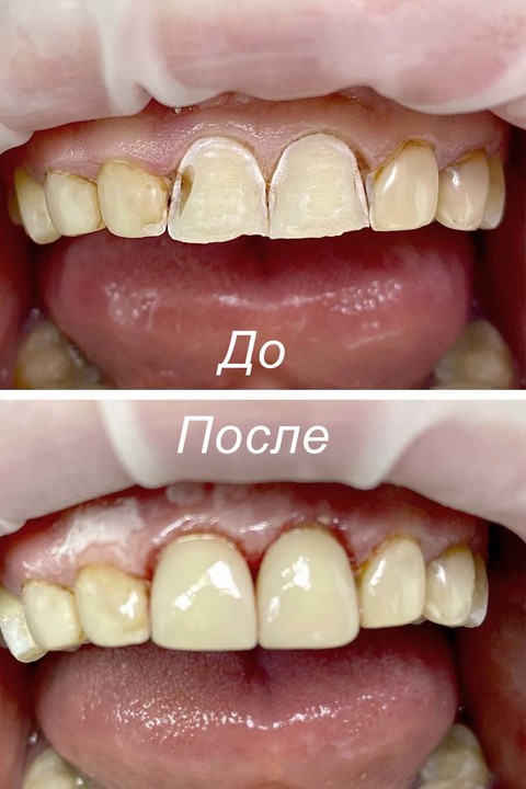 Фото работы врача «Егорочкина Анна Сергеевна» - Реставрация зубов светополимерным композитным материалом.